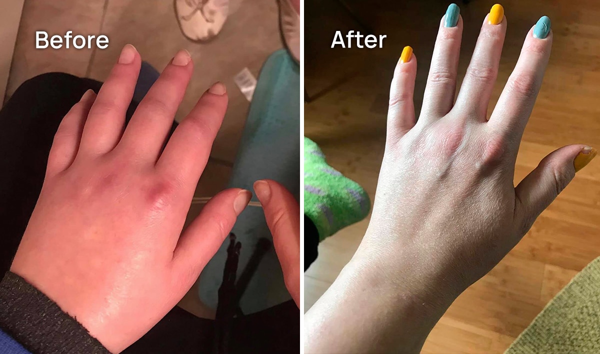 Hand CRPS Before and After treatment