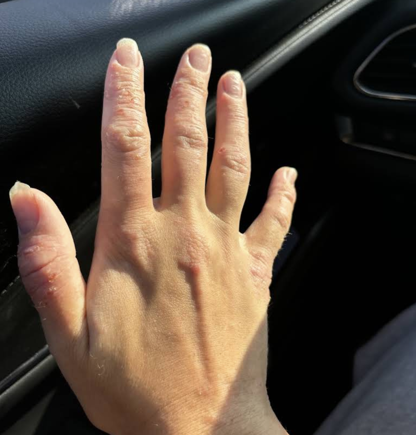 The Spero Clinic reviews - Kate Rowan Eczema Dermatitis Patient Before treatment 2